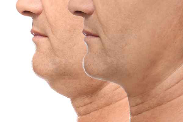 HIFU - Breakthrough in Anti - ageing 2 hifu results Willenhall