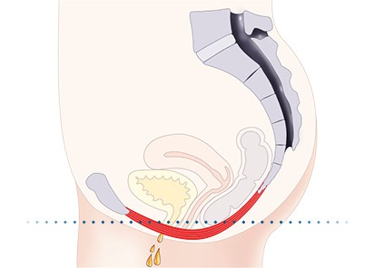 Pelvic-Floor Muscle Repair 5 Pelvic floor muscles Willenhall