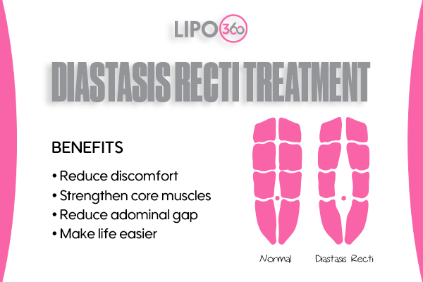 Revolutionising Muscle Repair: The Power of LIPO360 Body Sculpt Post-Injury 5 diastasis recti treatment Willenhall