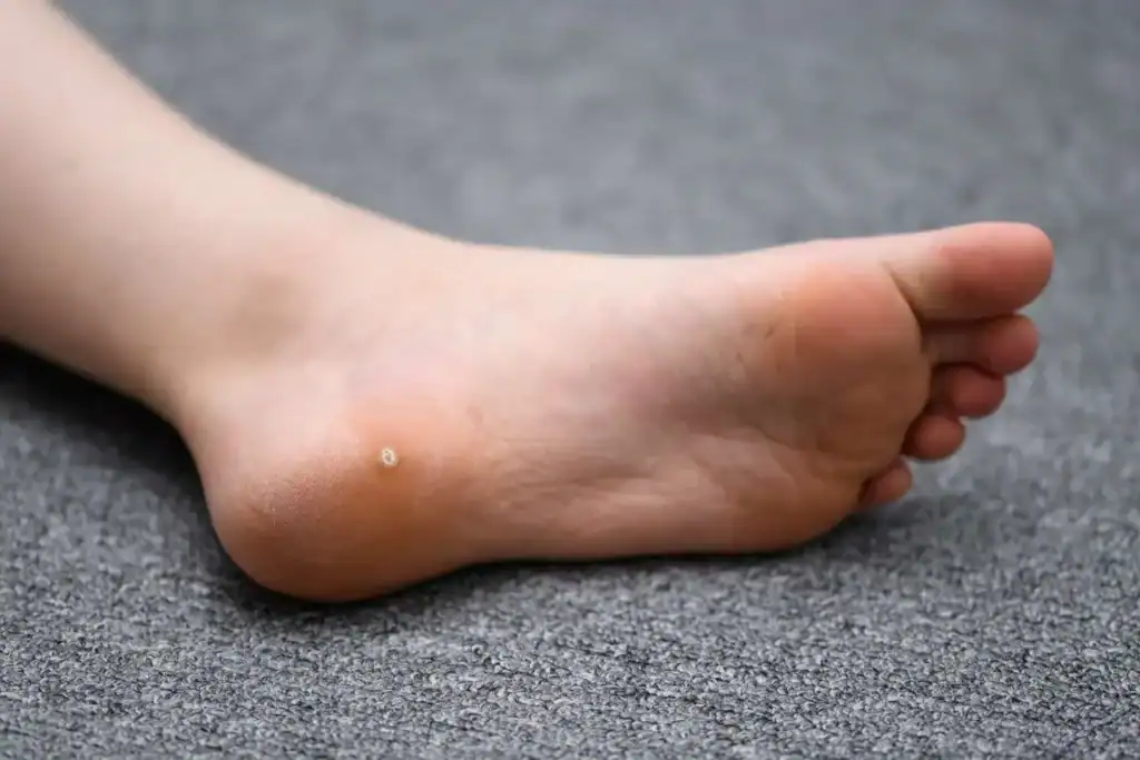 Cryotherapy For Warts And Also Verrucas 2 Image of verruca on the bottom of the foot that able to be treated with Cryotherapy Willenhall