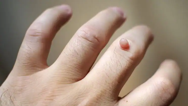 Cryotherapy For Warts And Also Verrucas 1 Image of blemish that Cryotherapy Willenhall can remove with Lipo 360.