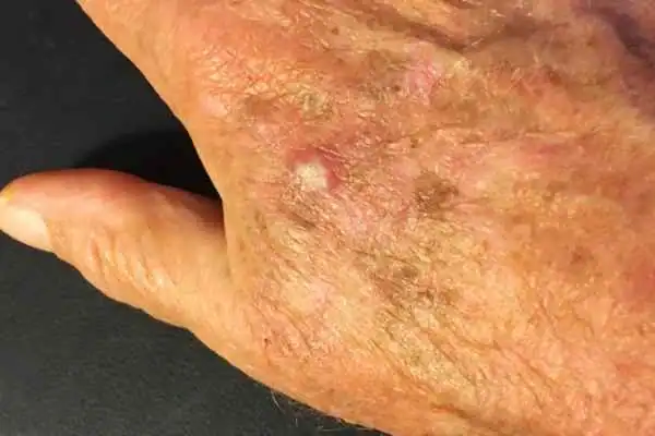 Cryopen For Actinic Keratoses 1 Image of Actinic keratoses Willenhall on a person hand