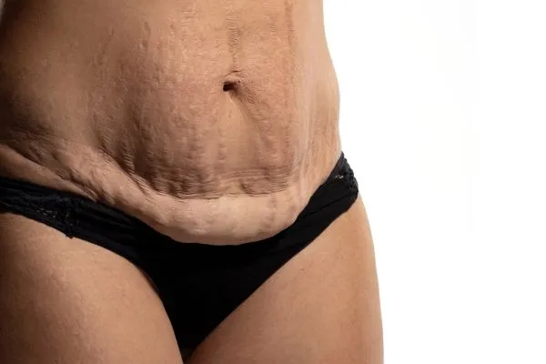 The Science of Skin Tightening 1 The science behind skin tightening Willenhall picture of a woman's sagging skin on the stomach